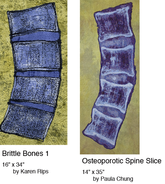 Brittle Bones 1/Osteoporotic Spine Slice